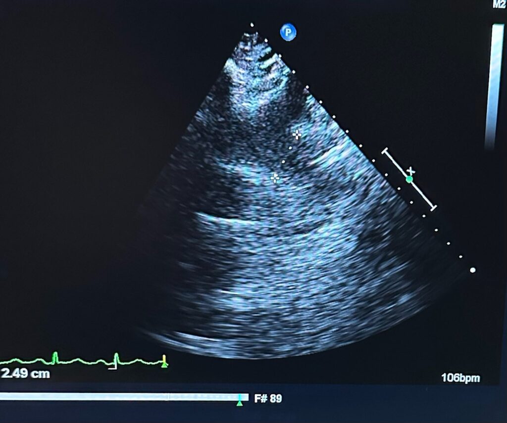 echocardigram