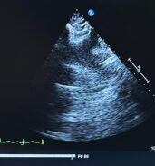 echocardigram